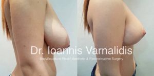  ανόρθωση-στήθους-breast-lift