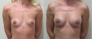 breast augmentation varnalidis